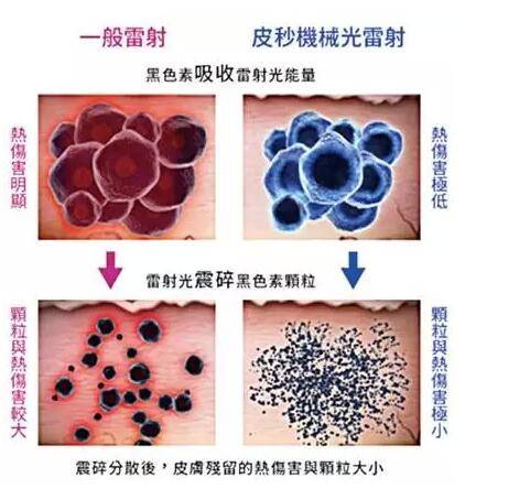 最新皮秒激光